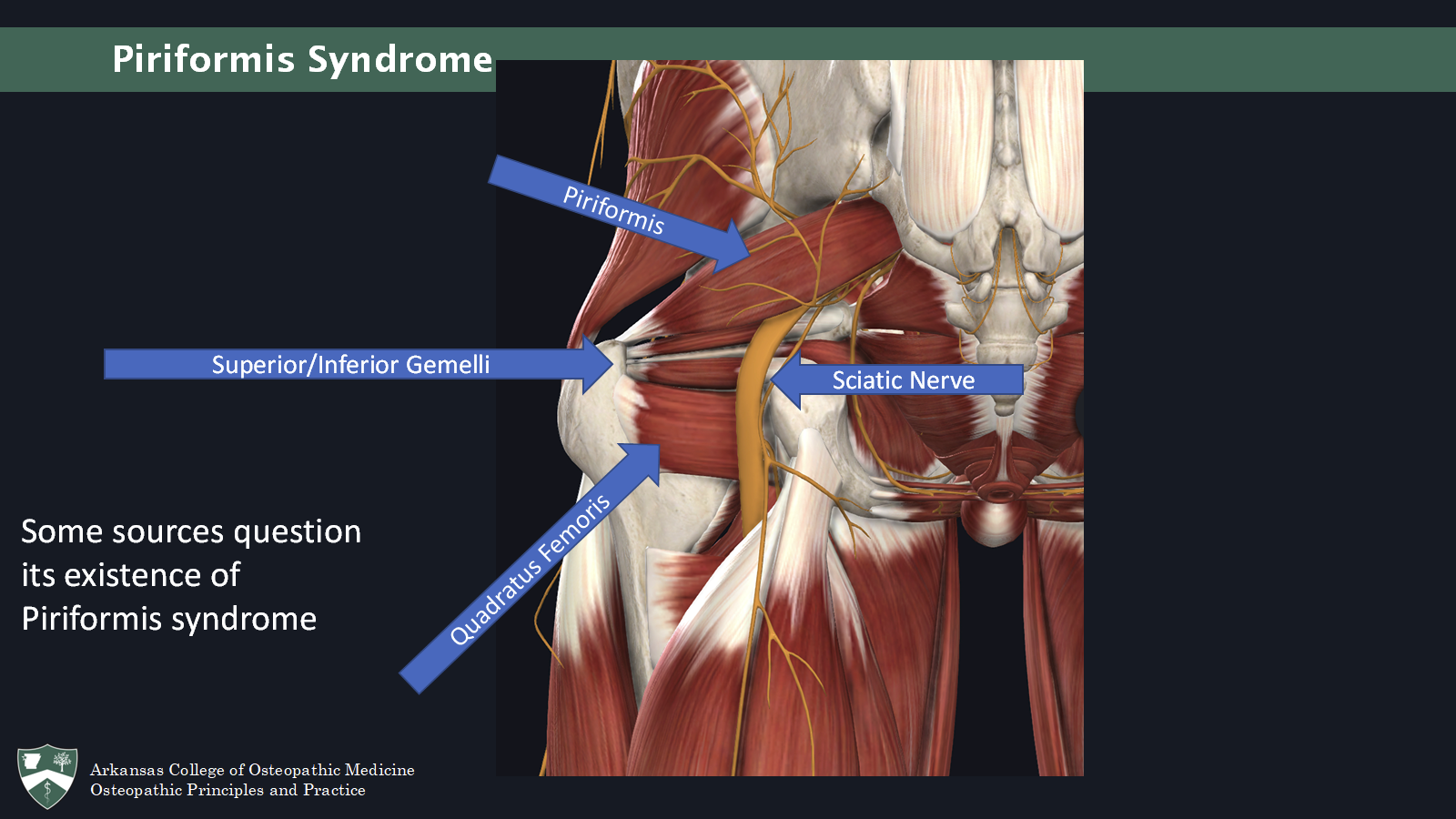 <p>More common in women</p><p>Pain in the gluteal region that travels down</p><p>Increases with sitting longer than 15-20 minutes and improves with ambulation</p><p>Contralateral SI pain</p><p>Parasthesias in posterior thigh and/or foot</p><p>Signs:</p><ul><li><p>Ipsilateral leg externally rotated</p></li><li><p>Ipsilateral leg short</p></li><li><p>Tenderness in the greater sciatic notch with/without palpable mass</p></li><li><p>Reproducible with active contraction or passive stretch</p></li><li><p>Straight leg raise may be positive</p></li><li><p>In most cases: sacrum is anteriorly rotated to contralat. side</p></li></ul><p>Tx: OMM (ME, CS- peeing dog, HVLA, artic, Still, consider sacrum/pelvis)</p><ul><li><p>untreated can result in chronic pain, parasthesias, or weakness</p></li></ul><p></p>