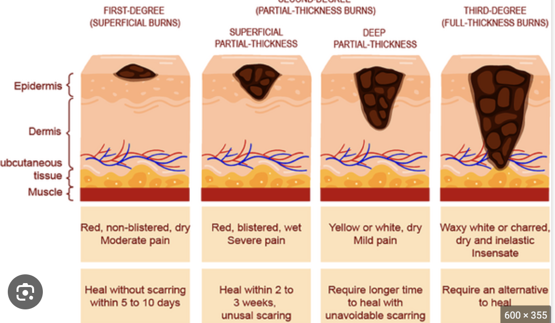 <p>First-degree burn</p>