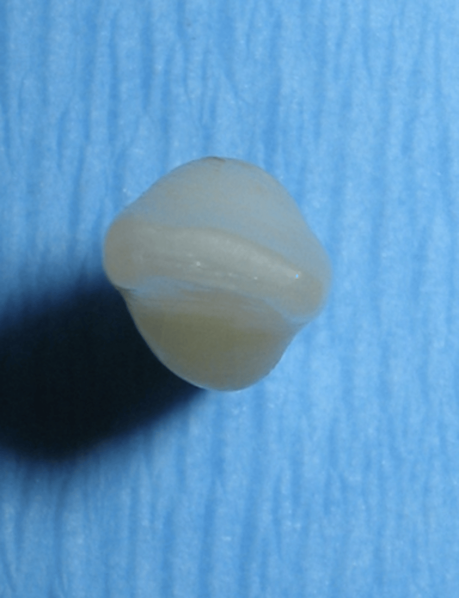 <p>- Appears twisted</p><p>- D more lingual than M</p><p>- "Distolingual twist"</p>