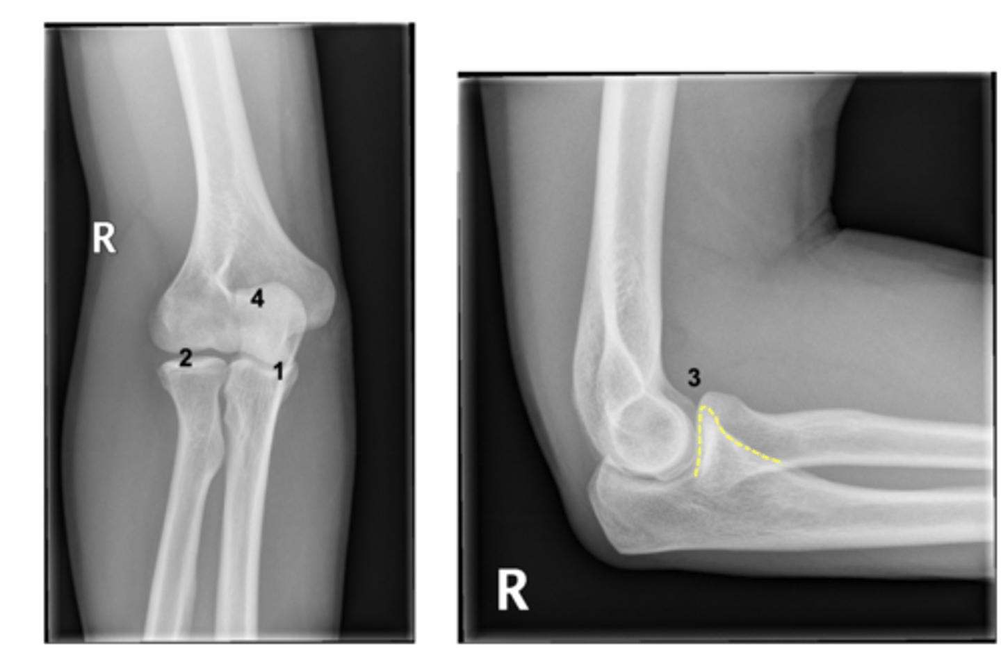 <p>Elbow joint complex: bony stability</p>