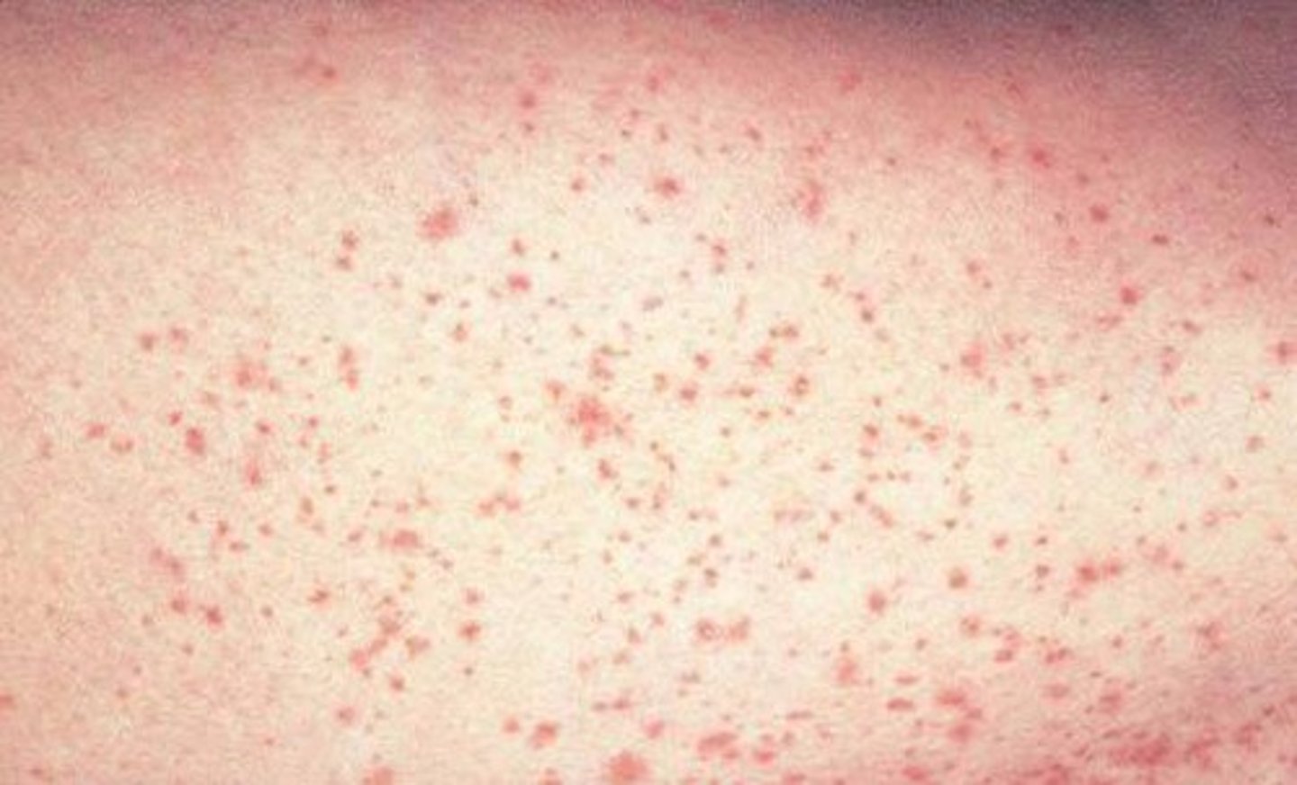 <p>smallest, flat, pin-point red/purple spot</p>