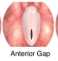 <p><span>Apart anteriorly only (near anterior commissure)</span></p>