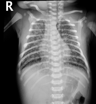 <p><strong>Meconium Aspiration Syndrome: CXR and Treatment</strong>&nbsp;</p><p>-CXR → patchy ________, overdistention (increased AP diameter), and ________ of the diaphragm</p><p>-Treatment → _________ care and assisted ventilation. In the case of persistent severe hypoxia, you could try surfactant therapy, inhaled ______ ______, or ECMO</p>