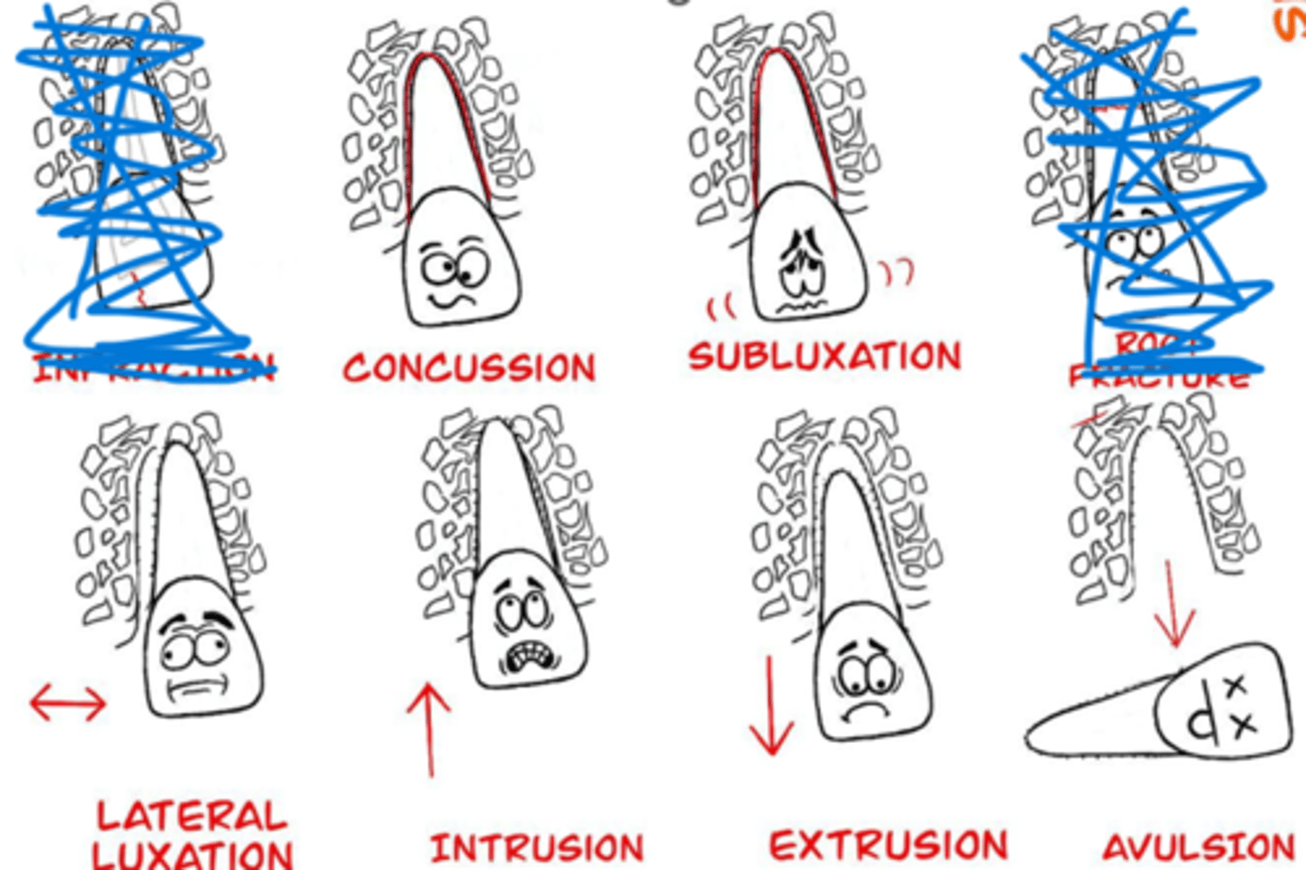 <p>Tooth fractures</p><p>• Root fractures</p><p>• Tooth displacement</p>