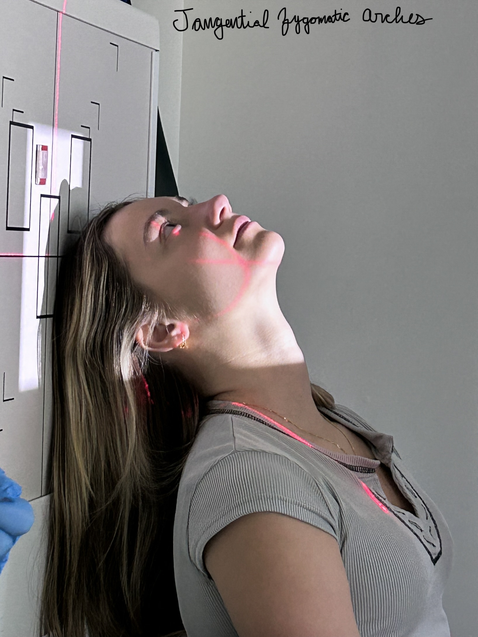 Tangential Zygomatic Arches