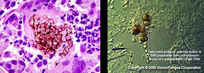 <p>How is <strong>chromoblastomycosis </strong>diagnosed?</p>