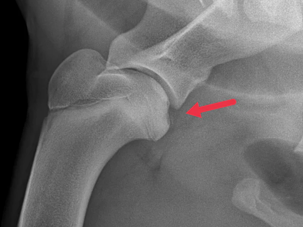 <p><strong>Osteochondritis dissecans (OCD)</strong> - osteochondrosis </p><ul><li><p>clinical form of osteochondrosis (disorder affecting cartilage + bone)</p></li><li><p>in this, cartilage thickens but <strong>fails to ossify correctly</strong>, meaning it does not turn into bone as it should. </p></li><li><p>often assoicated with joint incongruity and FCP</p></li><li><p>disorder of enchondral ossification, disruption lead to development of lesions in the cartilage → can result in detachment of bone and cartilage fragments. </p></li><li><p>the condition may result in a joint mouse (small fragment of cartilage/bone that becomes loose within a joint space)</p></li></ul><p></p>