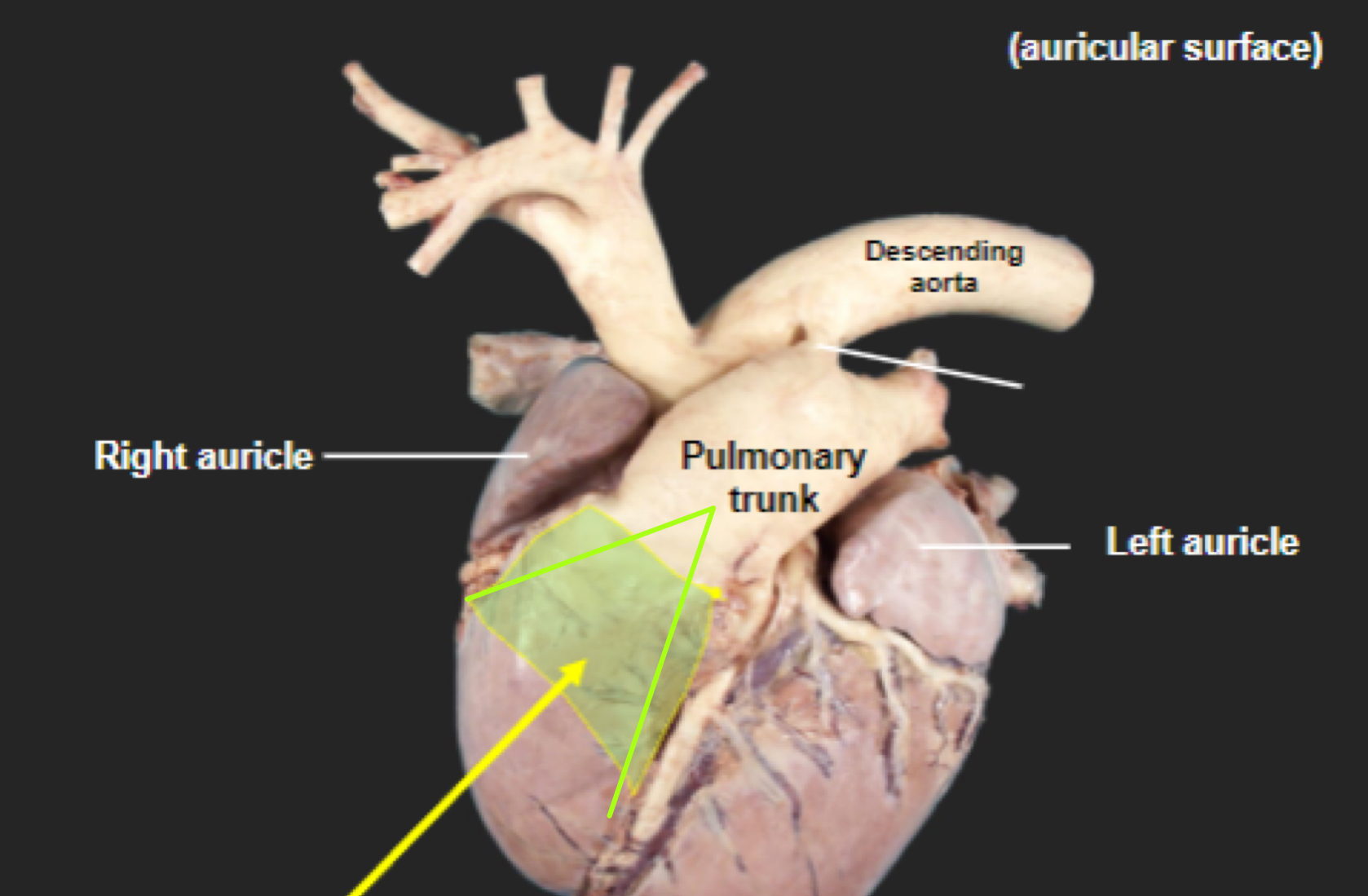 <p>Conus arteriosus</p>