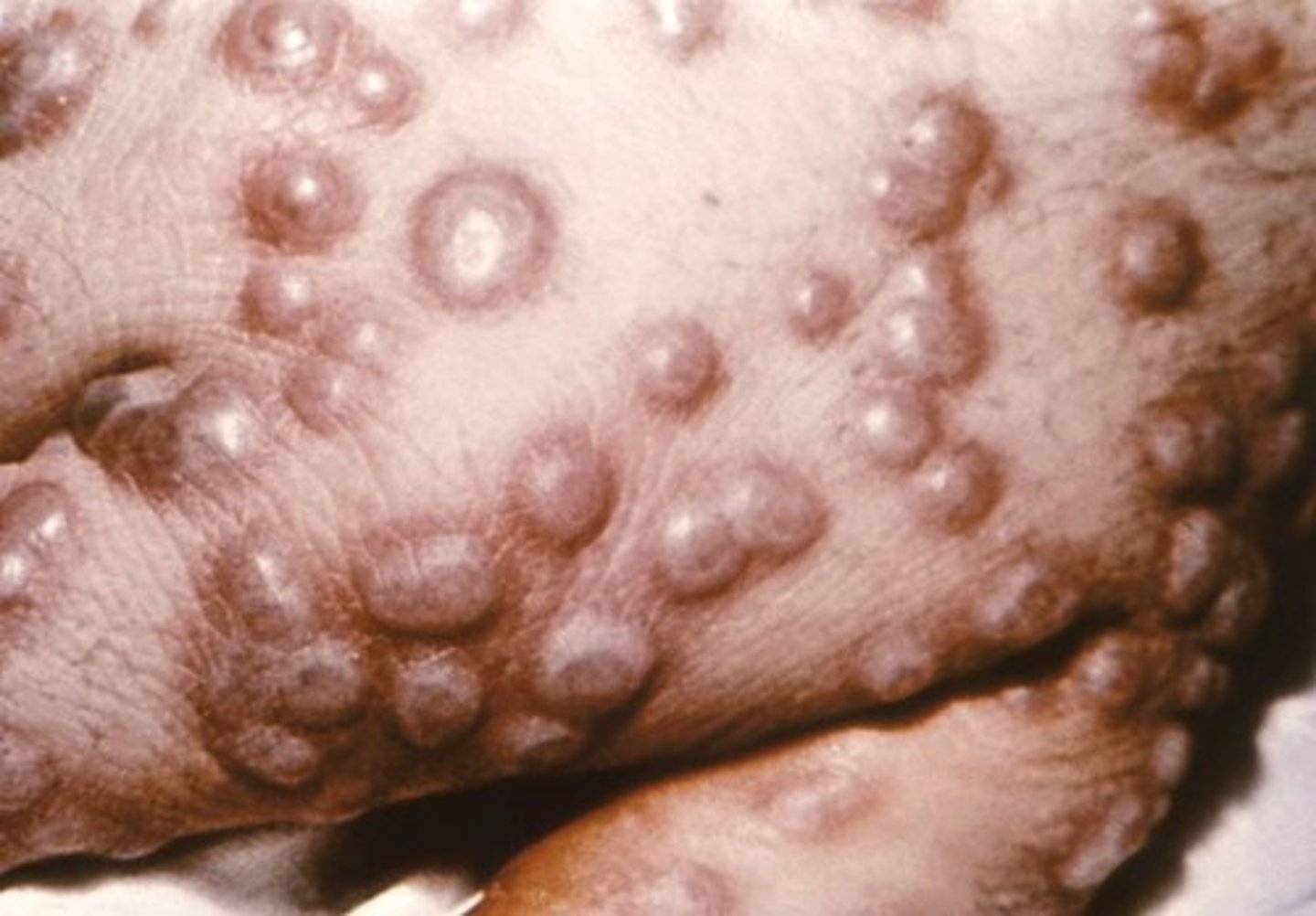 <p>Fever and an abundant rash that begins on the scalp, face, and trunk, progressing to itchy vesicles.</p>
