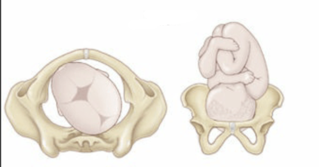 <p>back of the baby’s head is pointing toward the mother’s left back side.</p><ul><li><p>Baby’s Face: mother’s right front (up toward her belly button).</p></li><li><p>Baby is “sunny side up.”</p></li><li><p>Causes back labor (intense lower back pain) </p></li><li><p>Labor may be longer or require position changes to help baby rotate anteriorly.</p></li></ul><p></p>