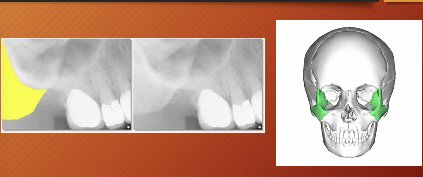 <p>Zygomatic bone - zygoma</p>