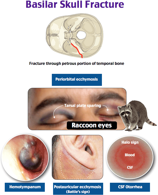 <p>Cerebrospinal Fluid Otorrhea (Clear fluid from ears)</p><p>Hemotympanum (blood behind tympanic membrane</p><p>Retroarticular Ecchymosis (Battle Sign or Mastoid bruising)</p><p>Periorbital Ecchymosis (Raccoon eyes)</p><p>CHRP → “Chirp” → With the ears that were fractured in the petrosal, you hear a <u>chirp</u> </p>