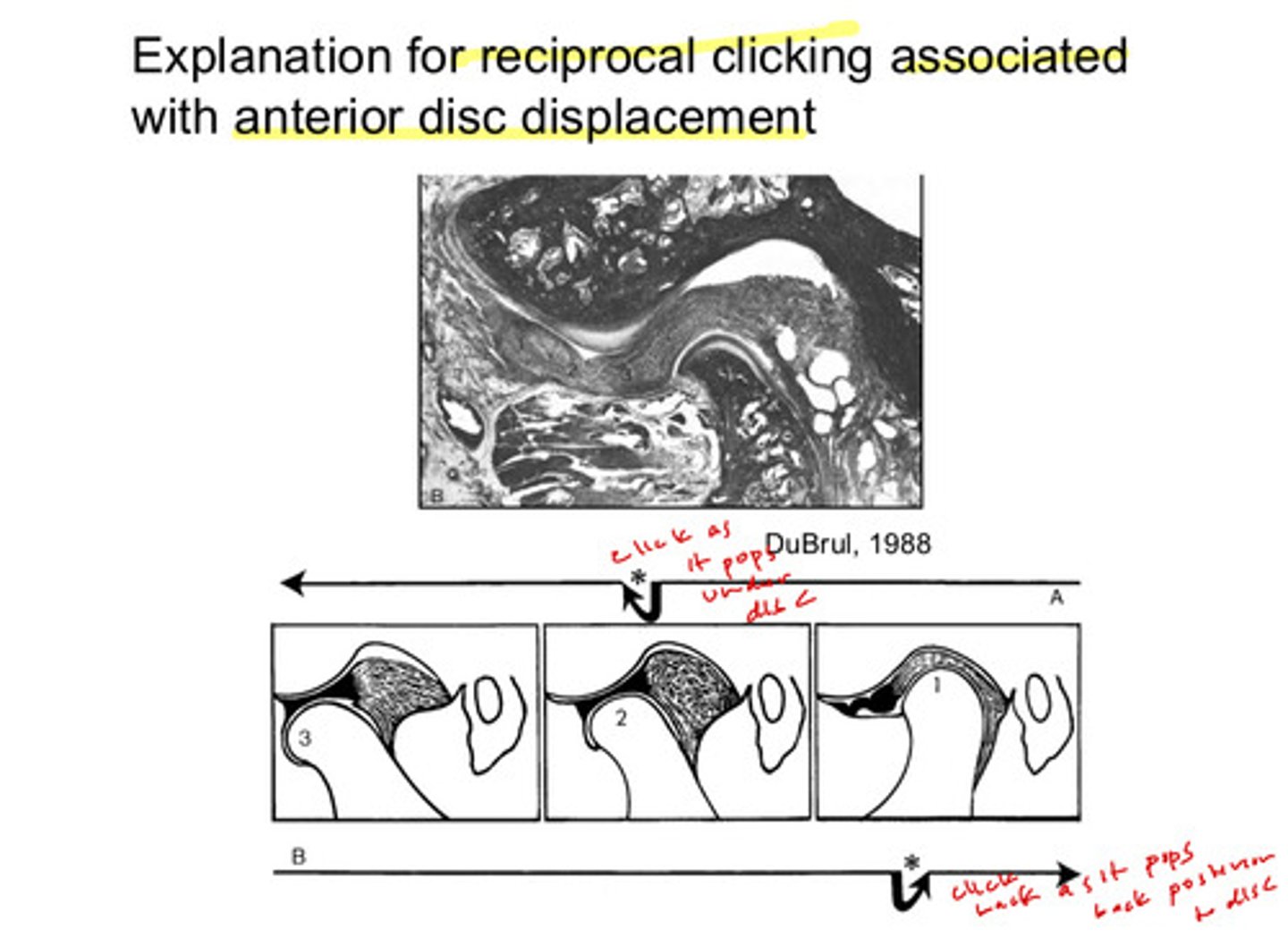 <p>the anterior disc displacement: the condyle clicks as it pops under the disc and clicks back as it pops back posterior too the disc</p>
