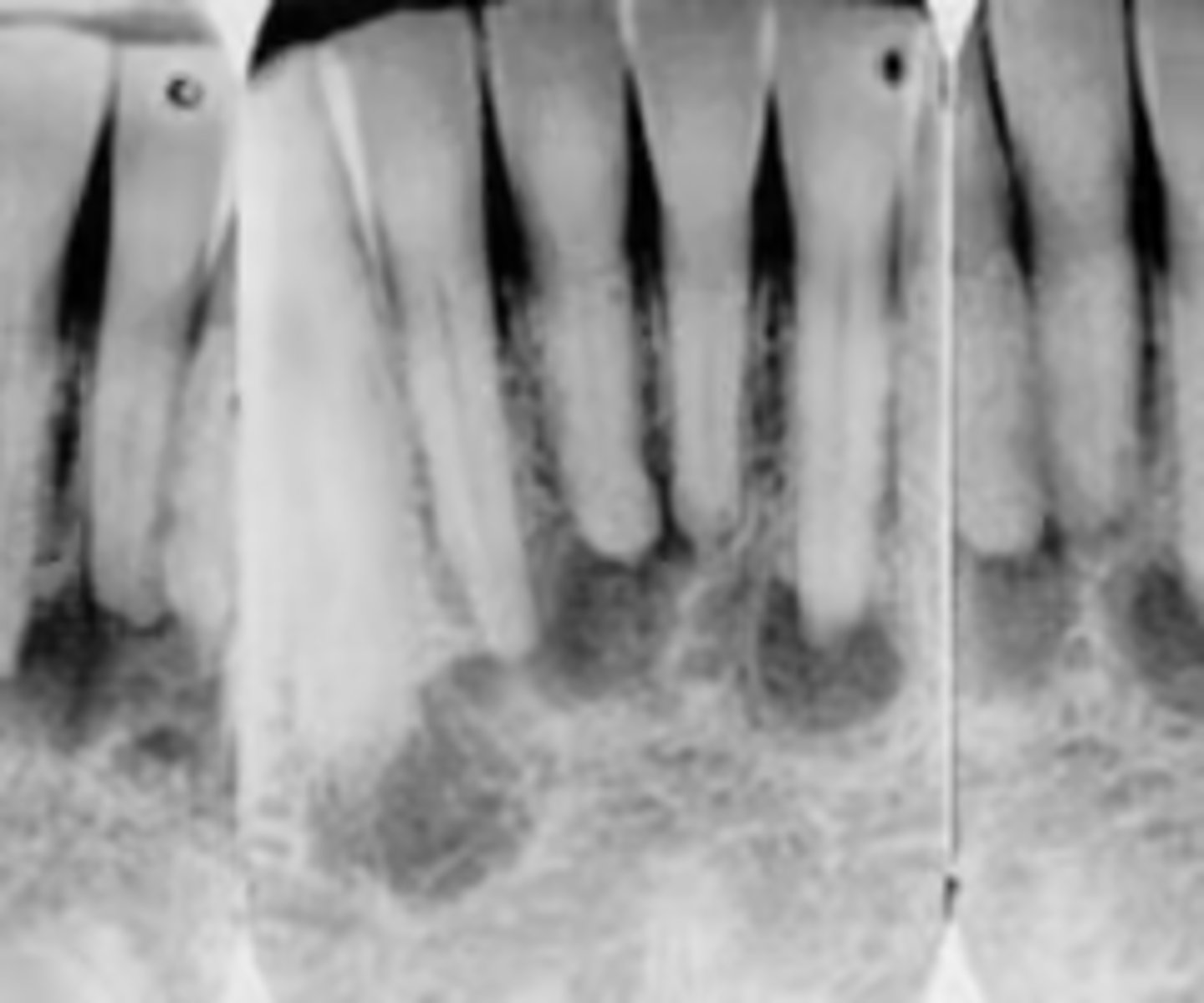 <p>What is the diagnosis?</p><p>30 y/o Black female presents asymptomatic to your office. Radiograph shows multiple apical radiolucencies that are < 1cm and are round and well-defined in the anterior mandible. The lamina dura is discontinued by the lesion. Tooth is still vital.</p>