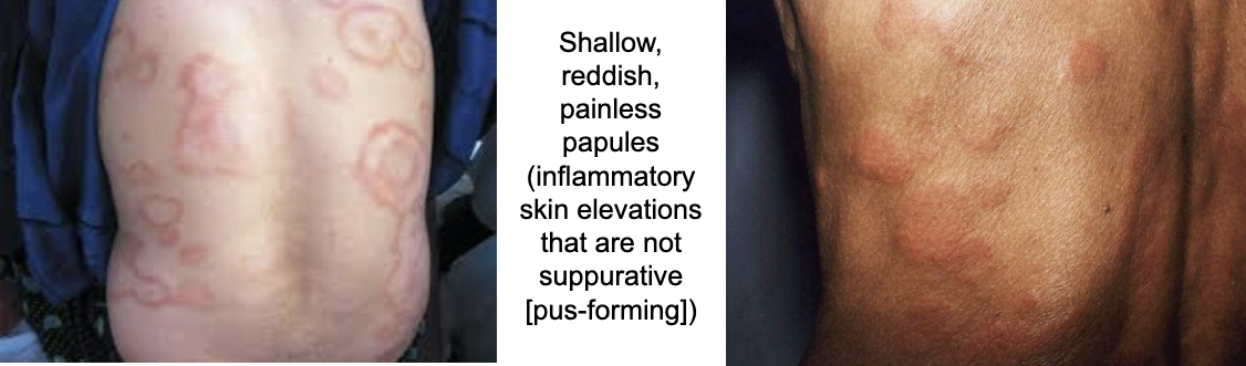 <p>localized mild form of disease. erythematous macules or papules on body. peripheral nerve involvement/damage produce areas of neuropathy: lack of feeling or touch sensations. host response: wall off organism from healthy neighboring tissue (granulomas). lebra cells well-confined within small nodules that don’t spread b/c of strong immune response</p>