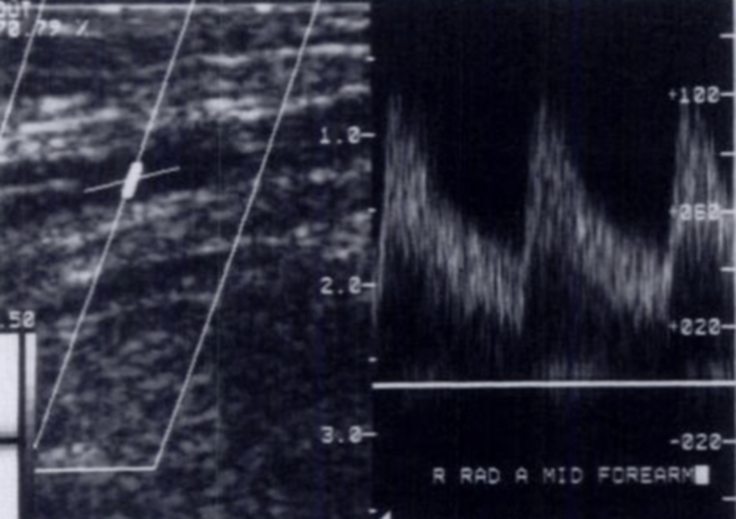 <p>Low-resistant waveform</p>