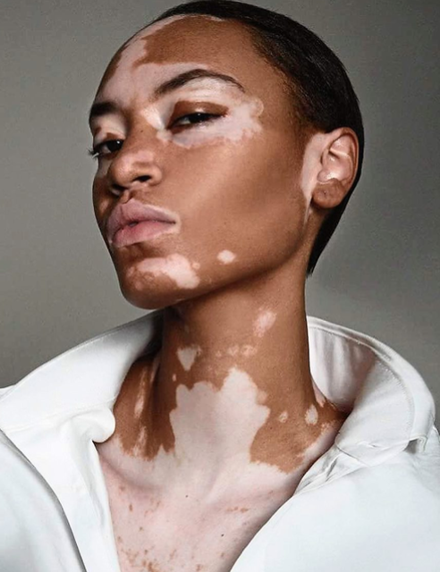 <p>Common Skin Variation</p><ul><li><p>Uneven patches on the skin</p></li><li><p>Common in African Americans</p></li></ul><p></p>