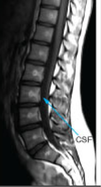 <p>Highlights fat as bright </p><p>Muscles as intermediate</p><p>Water (blood, CSF) as dark</p><p>Brain- gray matter is darker than white matter</p>