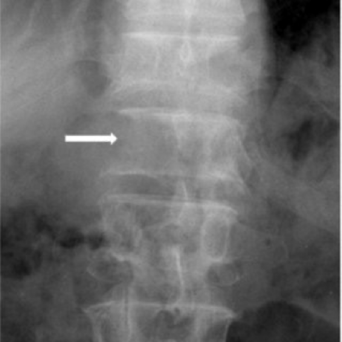 <p>Pedicle agenesis clinical significance</p>