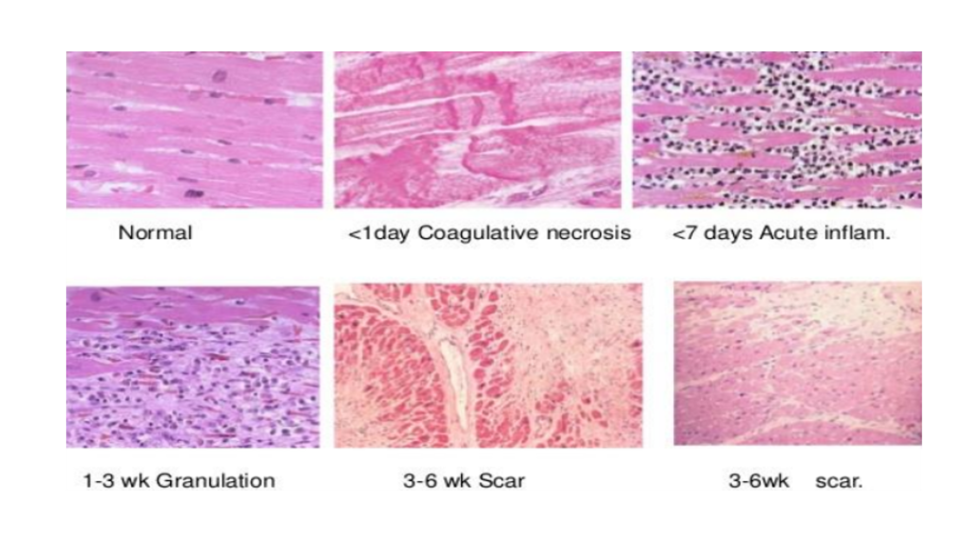 <p>Myocardial Infarction</p>