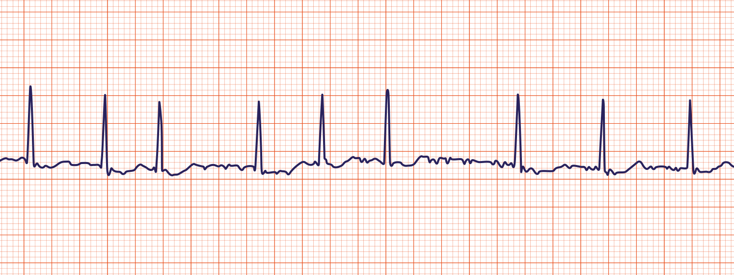 <p>irregular atrial activity</p>