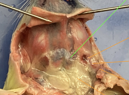 <p>lymph glands (picture unsure?)</p>