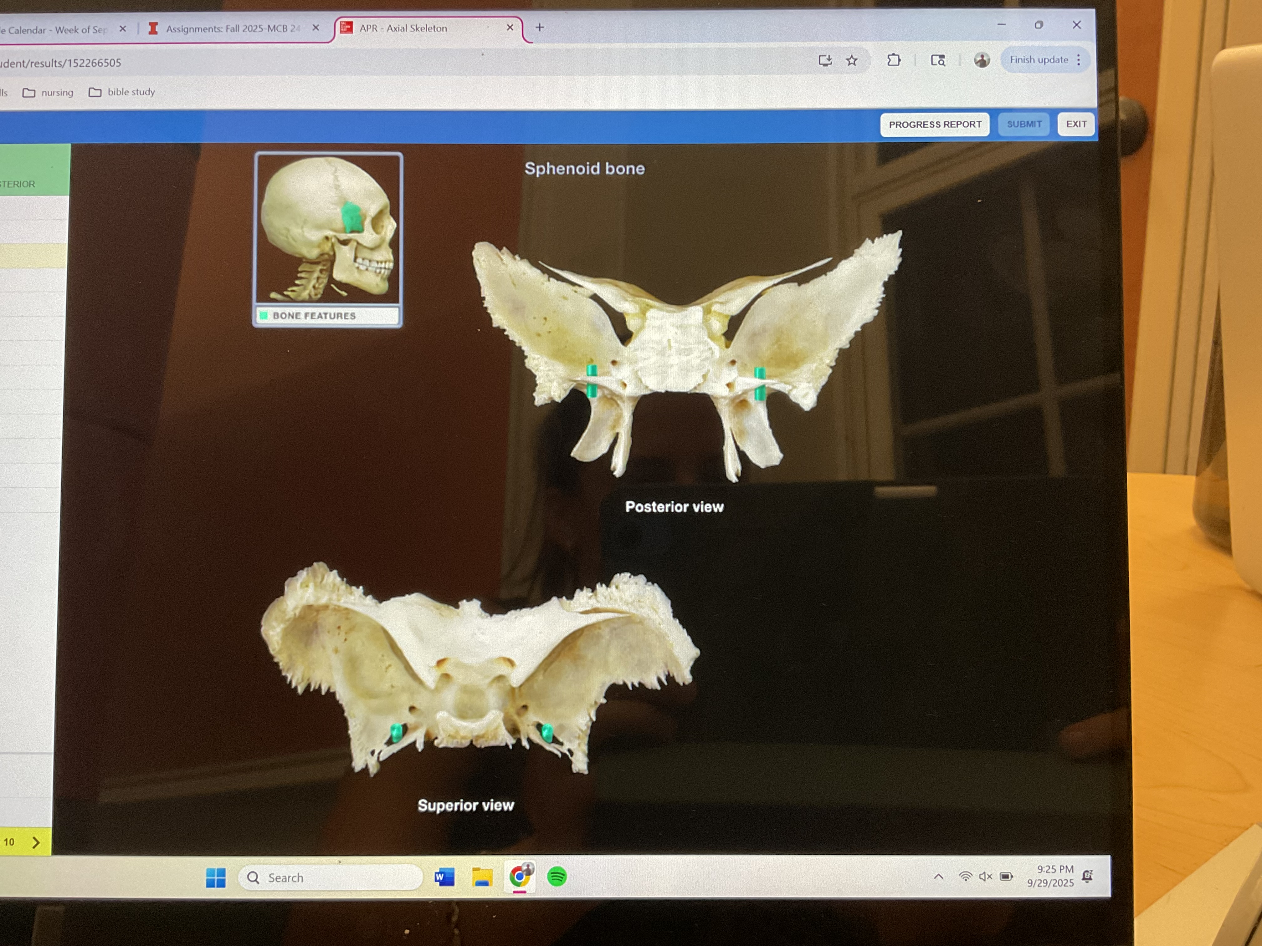 <p>Foramen ovale sphenoid bone </p>
