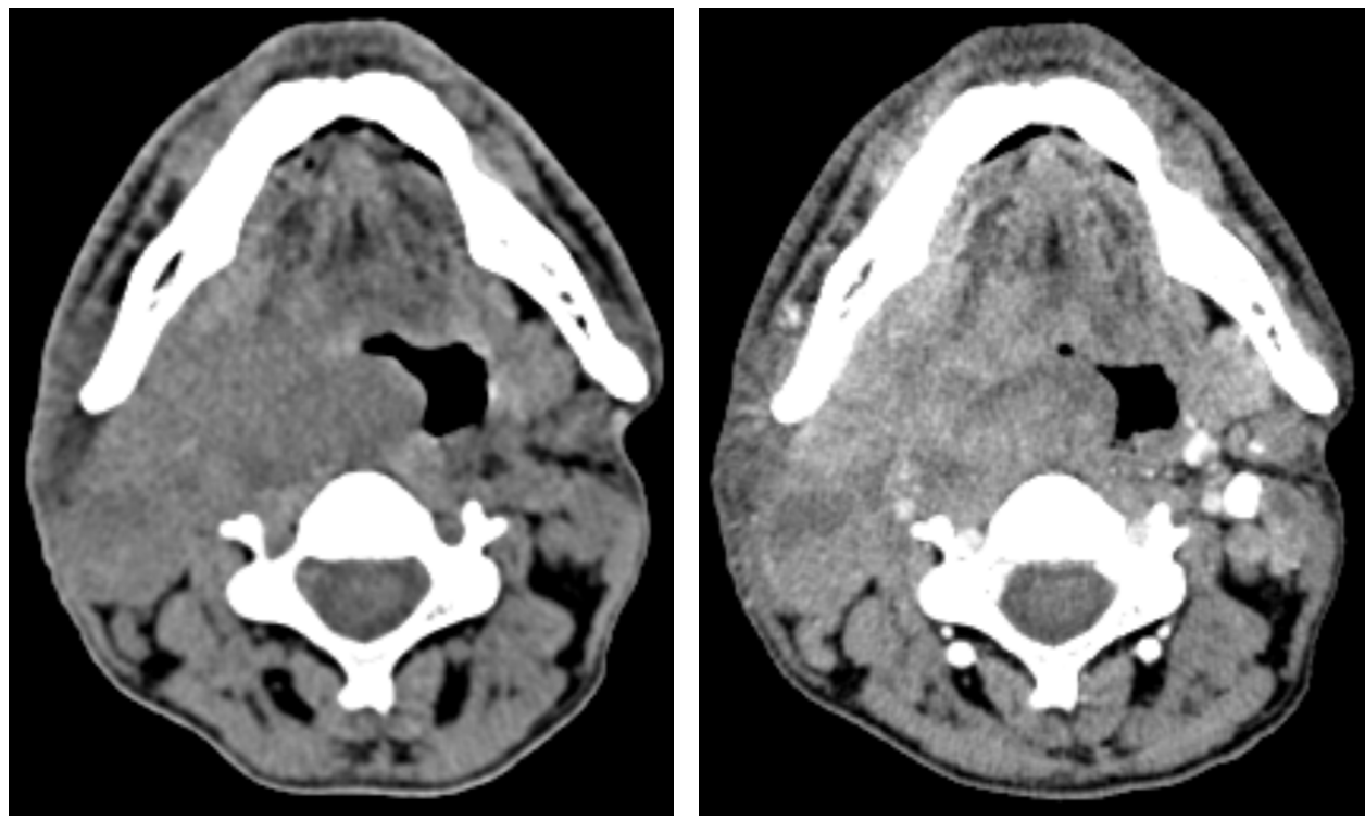 <p>What does this CT image show?</p>