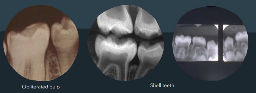 <ul><li><p>blue/grey translucent teeth </p></li><li><p>obliterated pulp chamber/ shell teeth </p></li></ul><p></p>