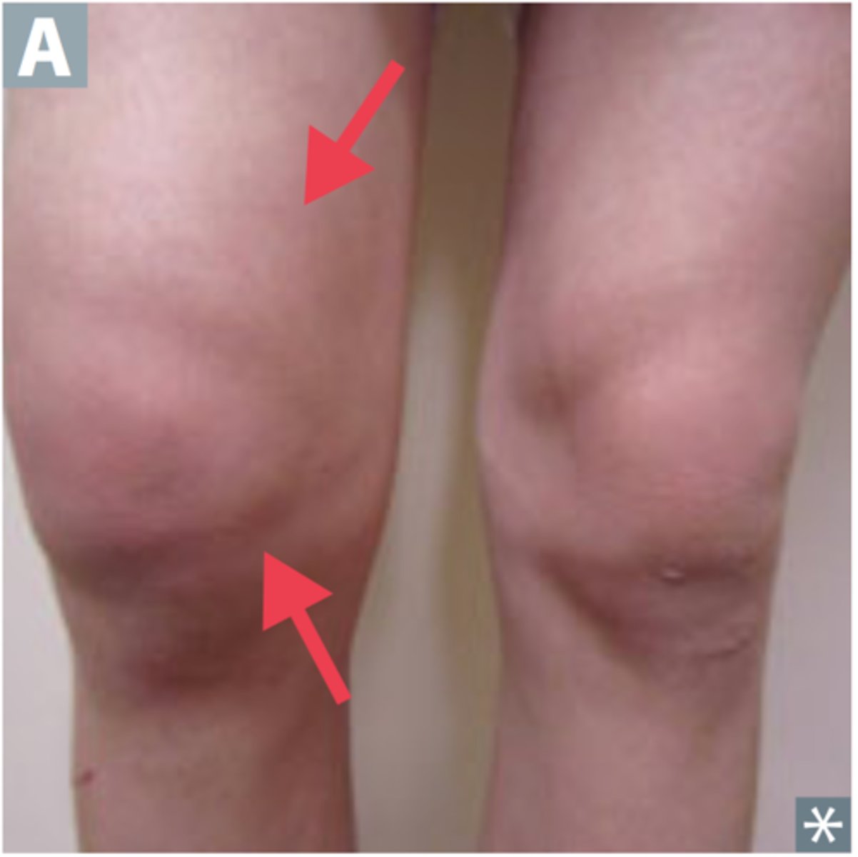 <p>monoarthritis characterized by intra-articular infection and joint destruction (S. Aureus - including MRSA - most common)</p>