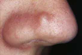 <p><span>A raised solid lesion which may be up to 0.5cm in size.</span></p>
