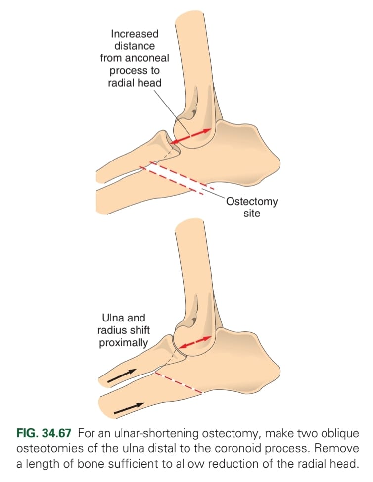 <ol><li><p>Biplanar long oblique osteotomy </p></li><li><p>Bone plating with bone grafts to lengthen radius</p></li></ol><p></p>