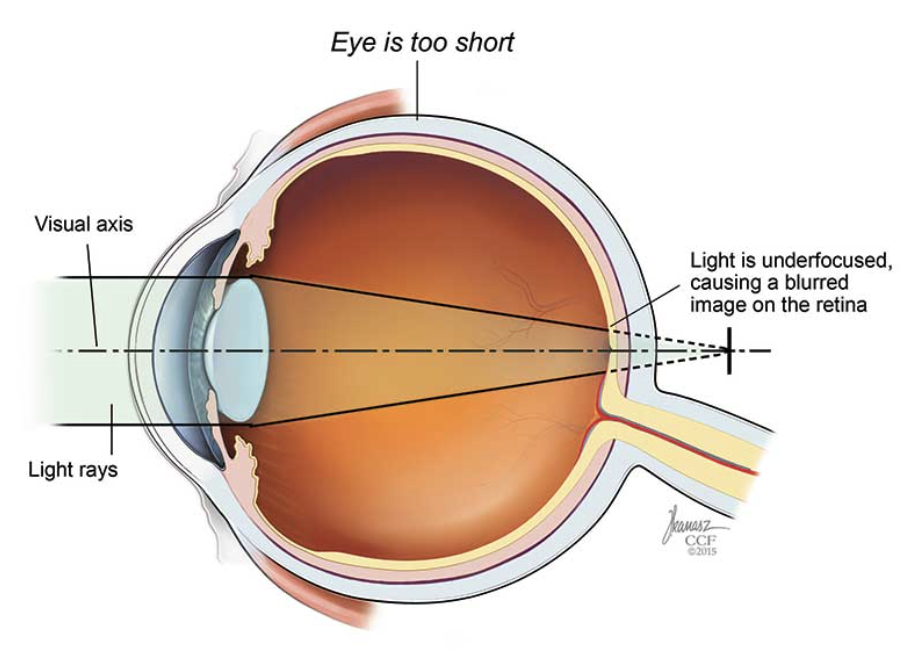 <p>long sightedness caused by a short eyeball. focused image falls after the retina</p>