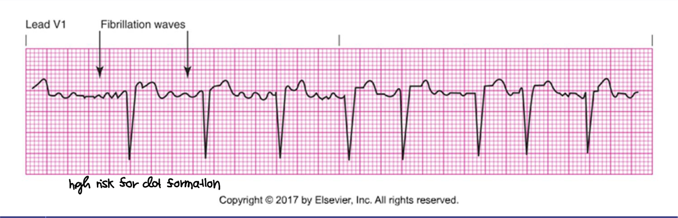 <ol><li><p>rate: atrial of more than 400 bpm and ventricular rate varies-</p></li></ol><p>→ caused by multiple atrial foci firing simultaneously (atrial chaos) </p><ol><li><p>rhythm: irregular rhythm → the atria is not contracting and is actually quivering</p></li><li><p>P waves: absence of countable P waves</p></li><li><p>PR interval: no measureable</p></li><li><p>QRS interval: usually normal (0.06-0.10) because ventricular conduction through the AV nodes and bundle branches is intact however the ventricular rhythm will be irregular </p></li></ol><p></p>