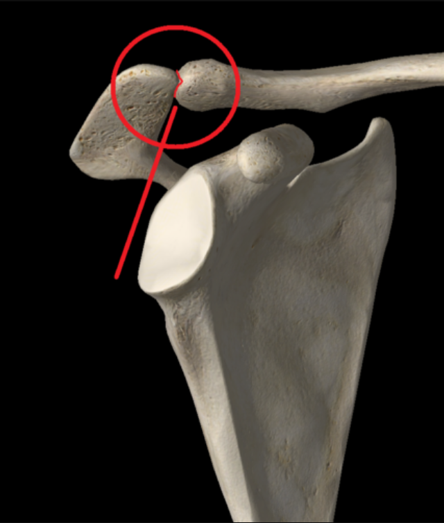 <p>False - it articles with the <strong>lateral</strong> end of the clavicle</p>