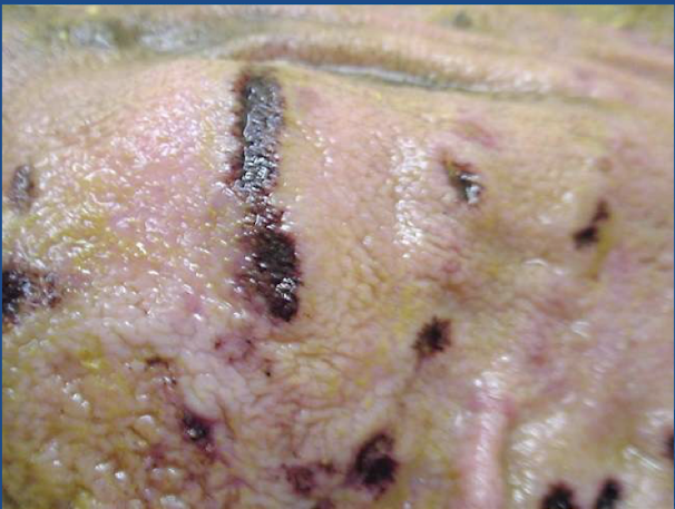 <p>What type of ulcer is this?</p>