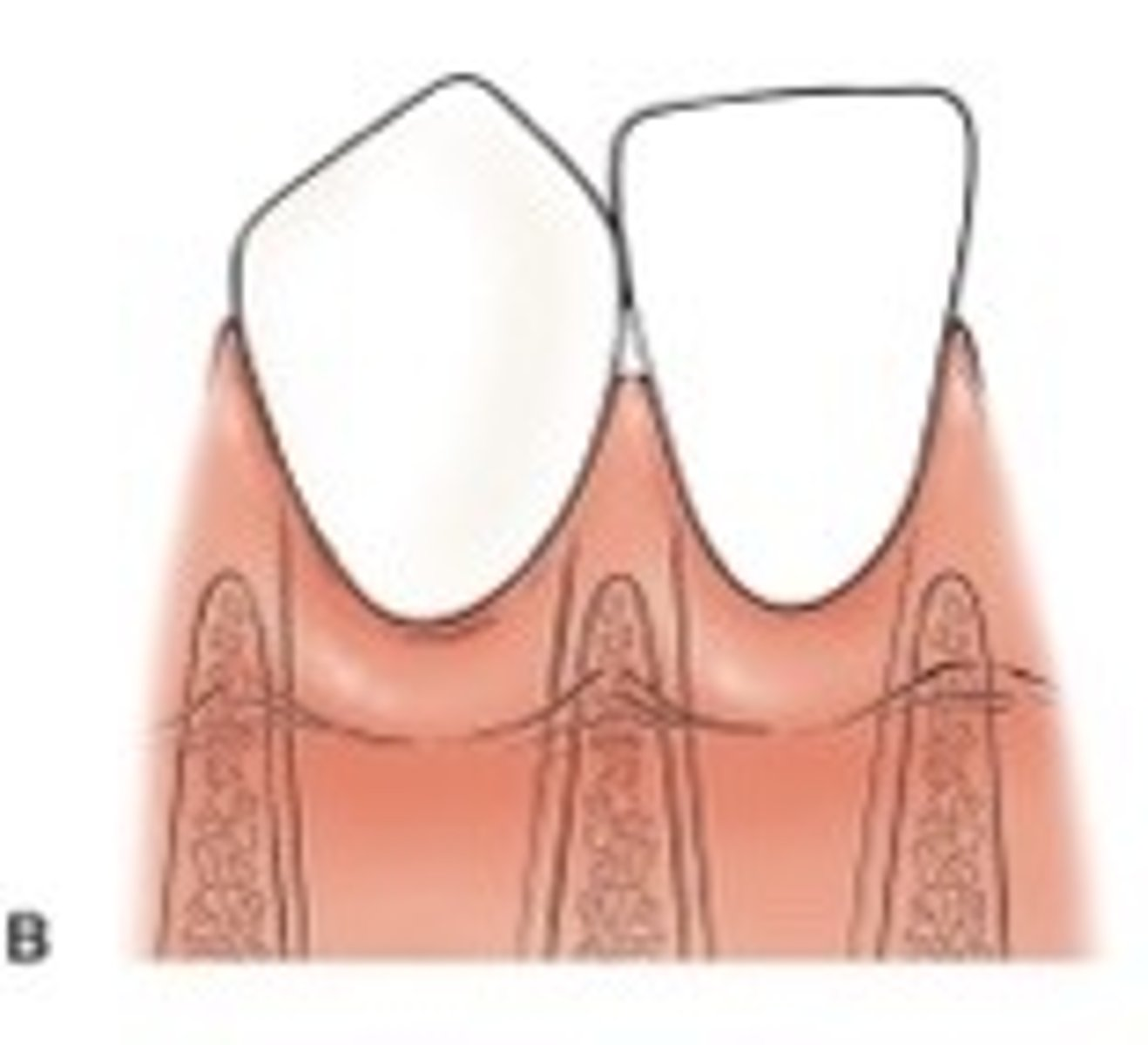 <p>The tip of the interdental papilla is apical to the contact point of adjacent teeth, but the interproximal CEJ is not visible. Papilla fills the entire interdental space.</p>