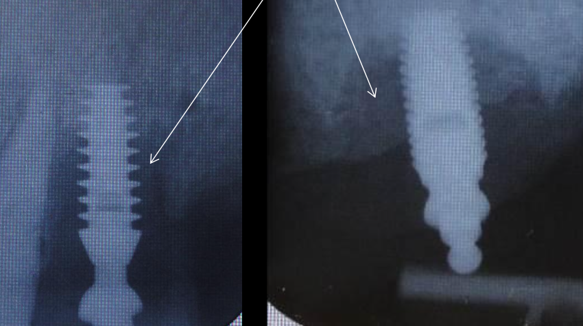 <p>Fibrous granulation tissue</p>