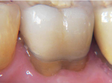 <p>above the gingiva</p>