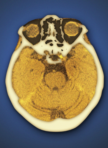 <p>Computed tomography (CT scan)</p>