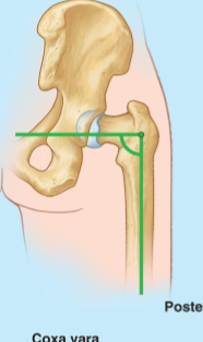 <p>A femoral neck–shaft angle &lt; 120° &amp; Neck–shaft angle ≤ 90°</p>