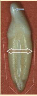 <p><mark data-color="purple" style="background-color: purple; color: inherit">mandibular lateral incisors #23 and #26; distal view</mark></p>