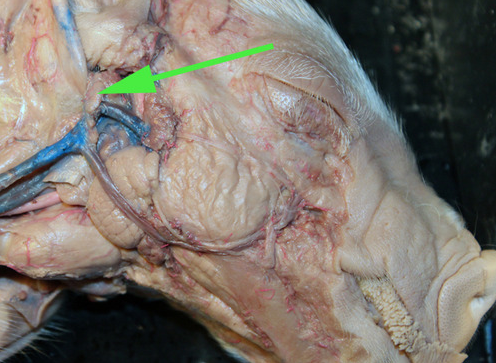 <p>The small structure marked by a green arrow is a lymph <strong>NODE</strong></p>