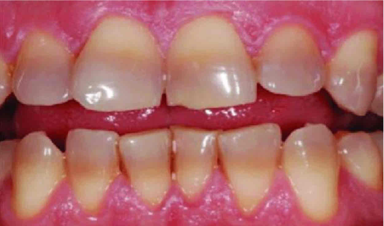 <p>use of antibiotic during childhood that bonds to calcium ions needed for enamel development in growing children</p>