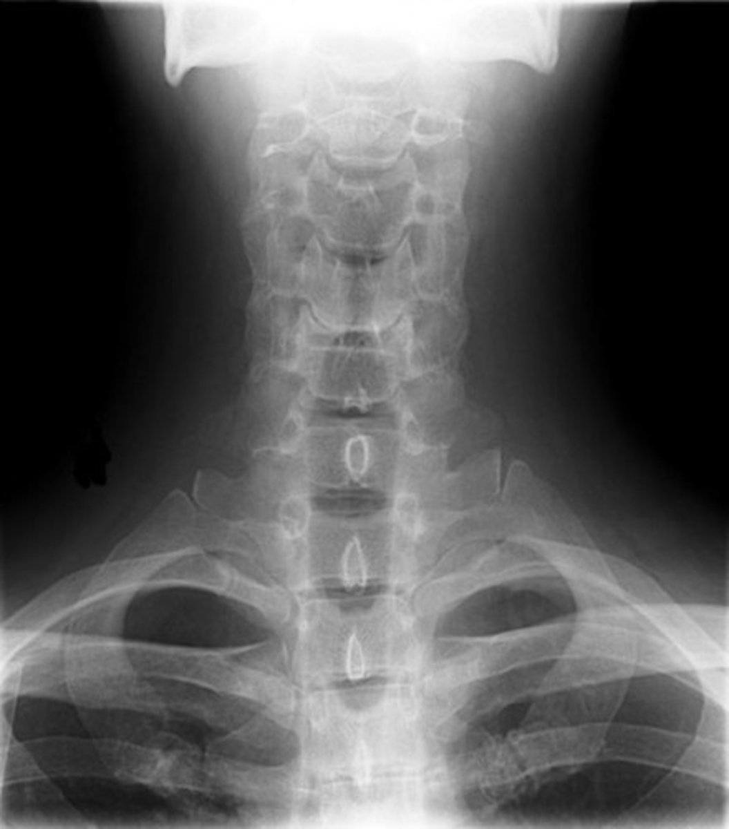 <p>AP spine view, look for:</p><p>pedicles: no erosion</p><p>alignment</p><p>count vertebral bodies</p><p>transverse processes</p><p>sacrum and SI joints</p>