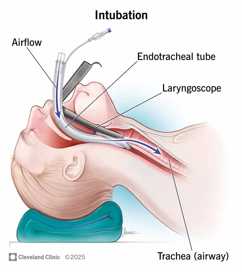 <ul><li><p>Tube inserted into the trachea</p></li><li><p>Inserted between the vocal cords into the trachea; cuff inflated below cords</p></li><li><p><strong>Typically not used &gt;14 days (consider tracheostomy if prolonged)</strong></p></li><li><p>Indications:</p><ul><li><p>Mechanical ventilation</p></li><li><p>Severe respiratory failure</p></li><li><p>Airway protection (e.g., ↓ LOC, aspiration risk)</p></li><li><p>Cardiac arrest</p></li><li><p>Post-op support (e.g., CABG)</p></li><li><p>Severe trauma (burns, facial trauma)</p></li><li><p>Neuromuscular disease (e.g., ALS)</p></li></ul></li></ul><p></p>