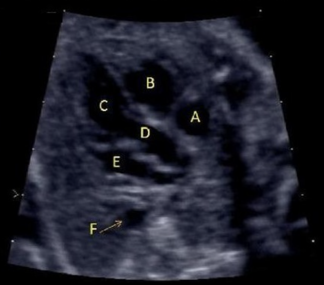 <p>what is letter F</p><p>a) LVOT</p><p>b) left atrium</p><p>c) aorta</p><p>d) coronary sinus</p><p>e) right atrium </p>