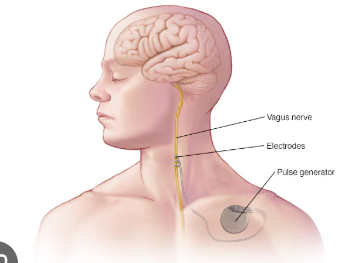 <p>electrically stimulating the vagal nerve with a small battery powered implant </p>