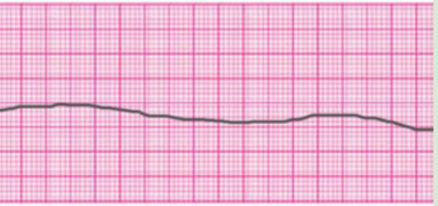 <p>Failure of the sinus node → no assumption of pacemaker activity by other areas → no cardiac output, no perfusion, and no pulse</p>
