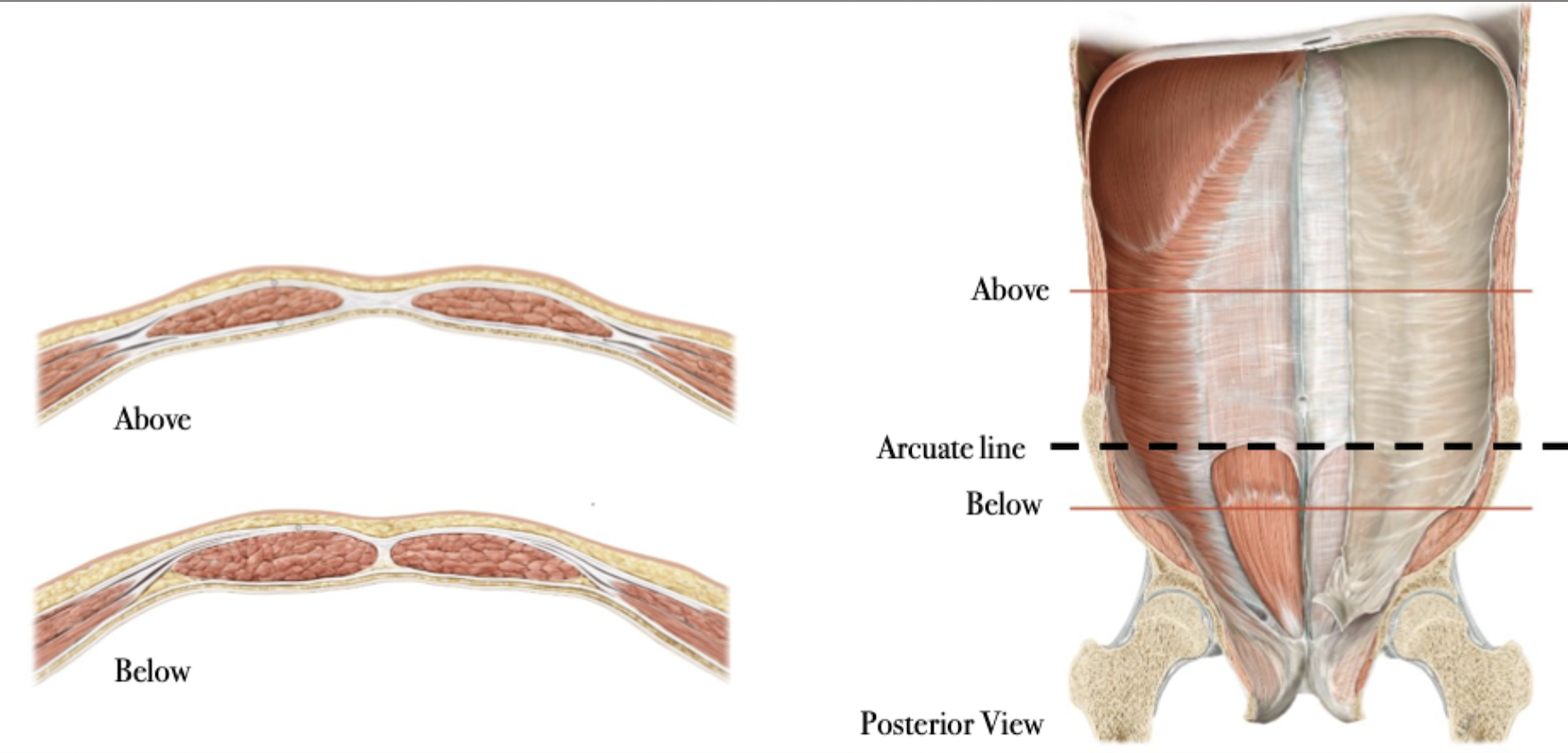 <p>Location</p><ul><li><p>Above or below the arcuate line</p><ul><li><p>Between the umbilicus &amp; pubis</p></li></ul></li></ul>